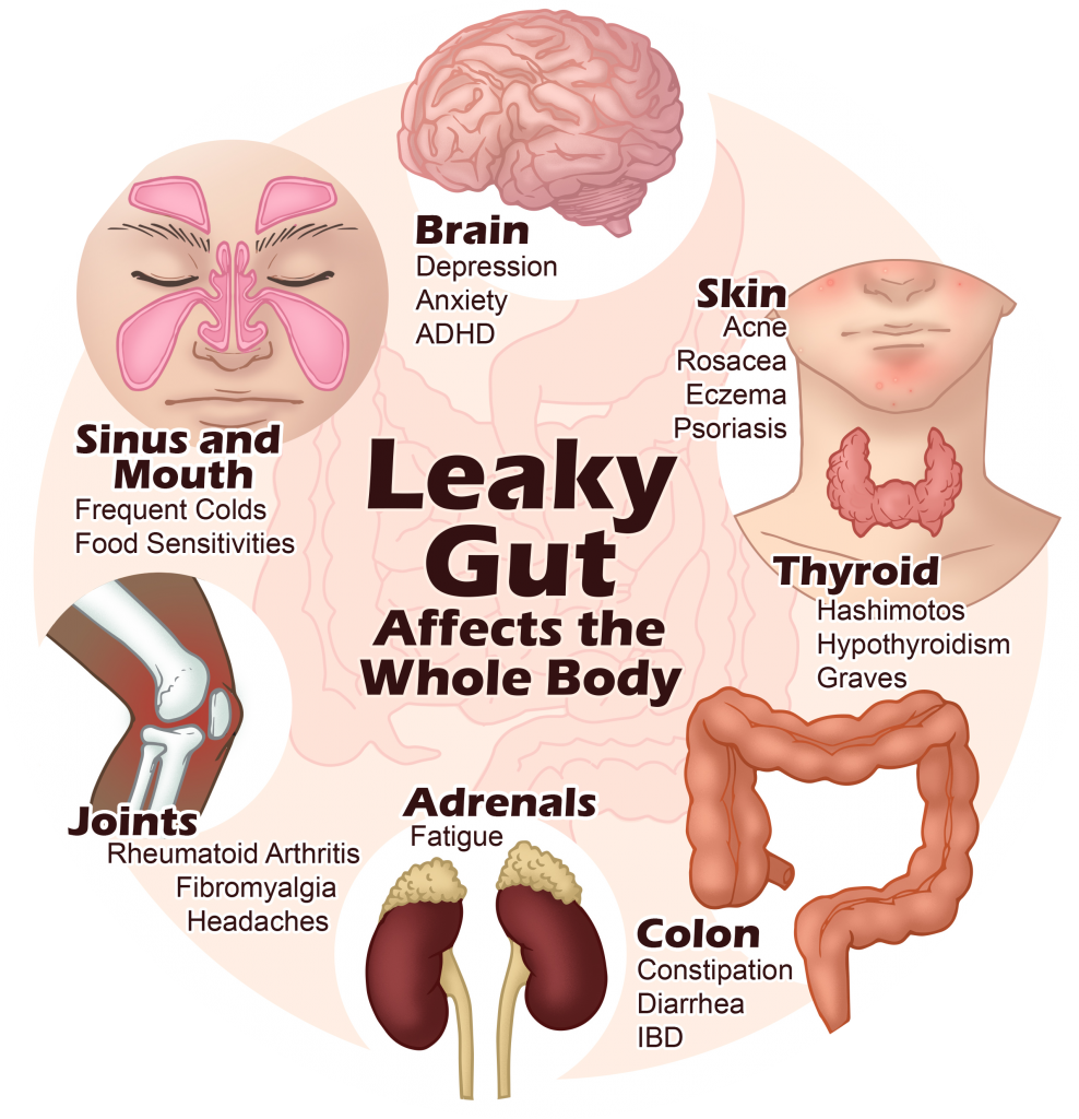 5 Step Formula to Heal Leaky Gut Naturally