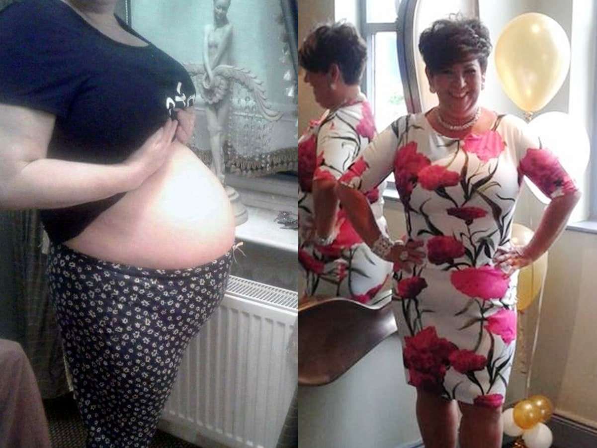 A Uterine Fibroid Made This Woman Look Like She Was ...