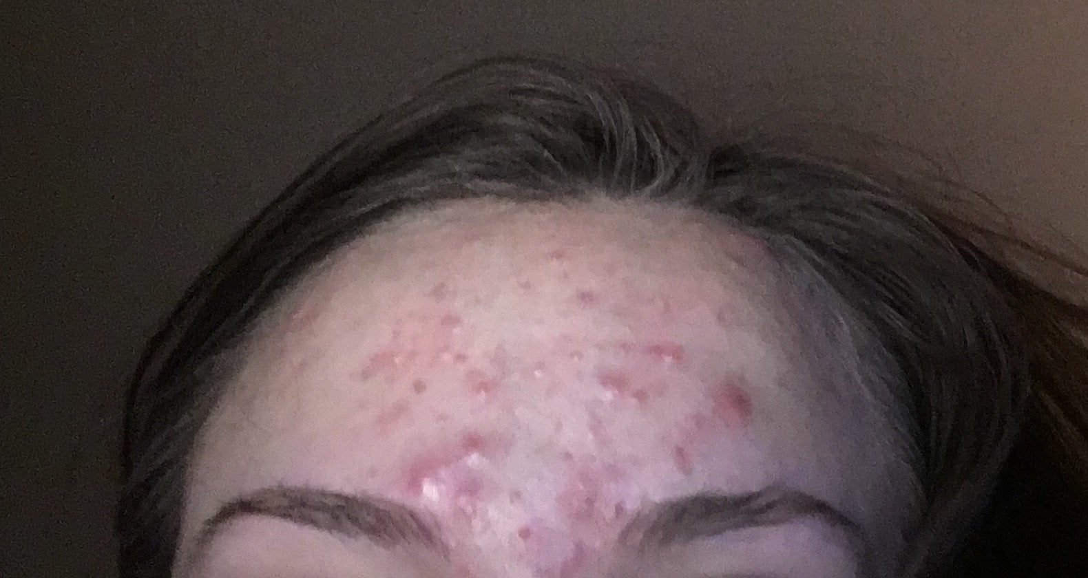 [Acne] Why is my forehead just suddenly like this?!! DIY ...