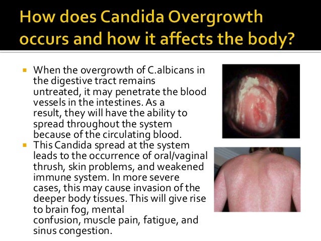 Best Probiotic For Candida