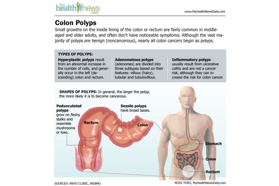 Colon Cancer: Causes, Symptoms and Treatments