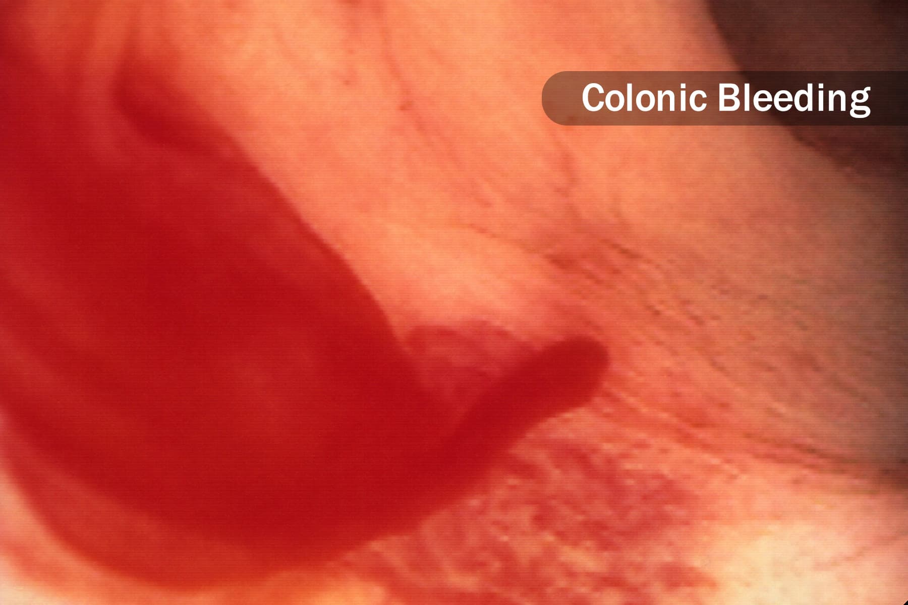 Colonoscopy: How to Prepare, How It Feels