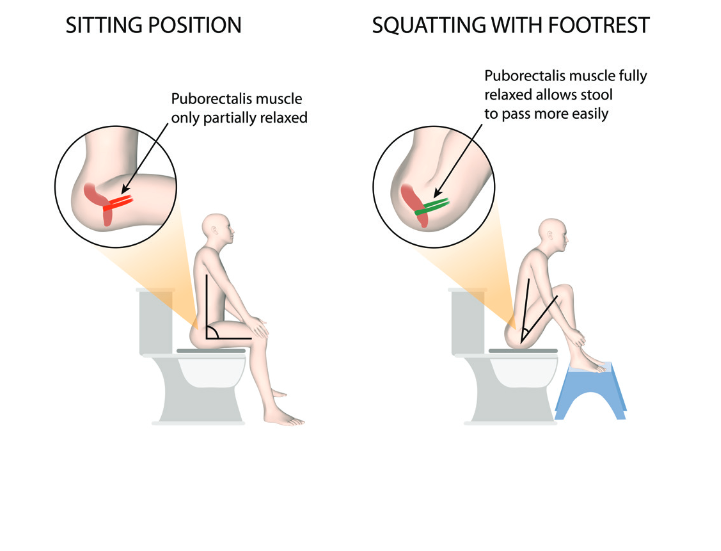 Constipation: Proper Toilet Sitting Position