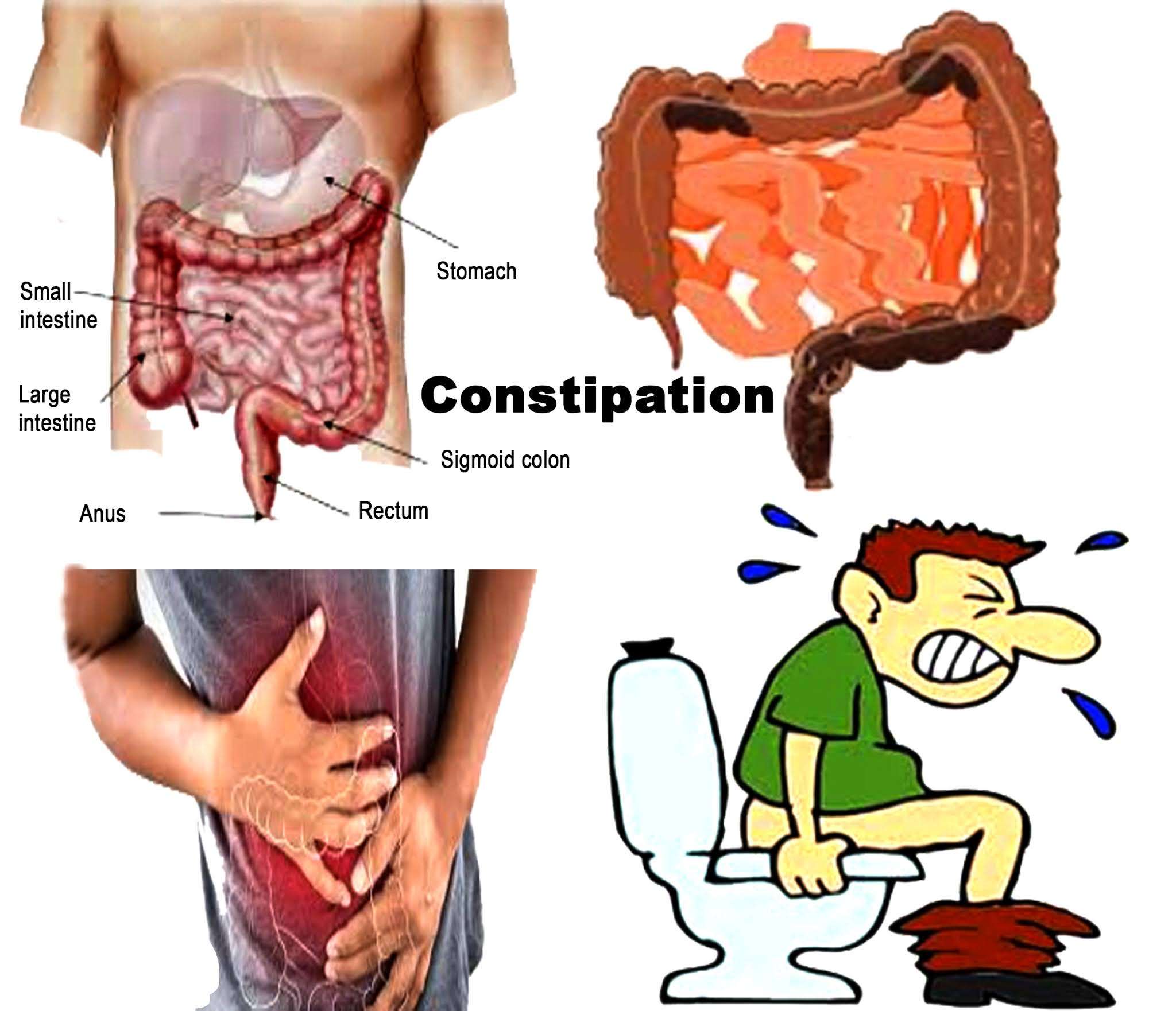 Constipation: Symptoms, Causes, Prevention, and Treatment.