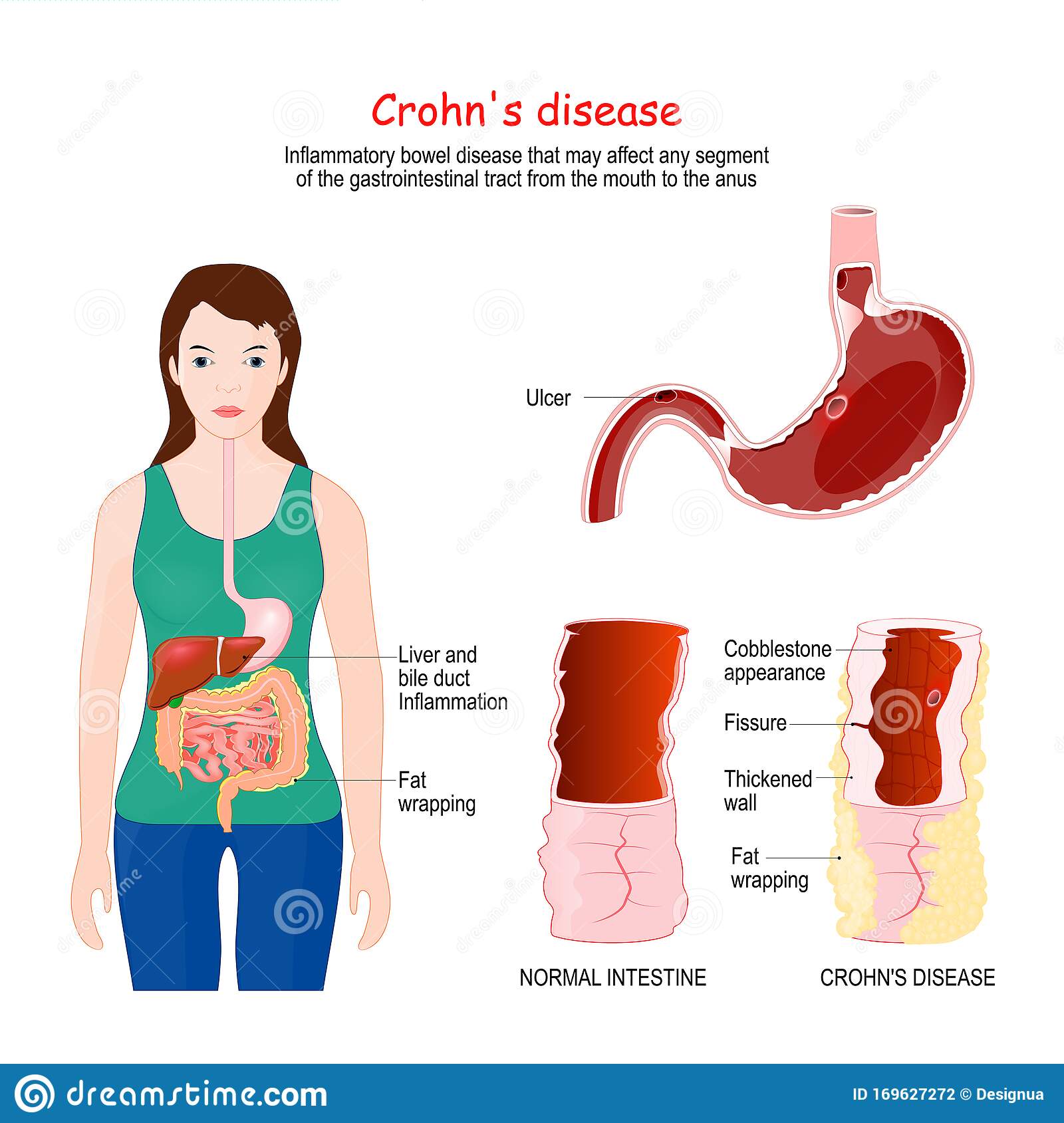 Crohn`s Disease Is A Syndrome That Affects The Digestive System. Its ...