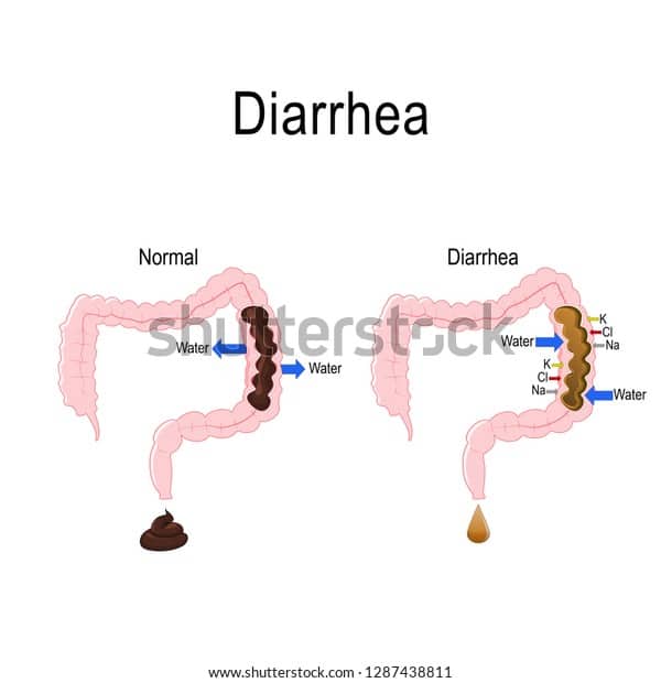 Diarrhea After Normal Stool