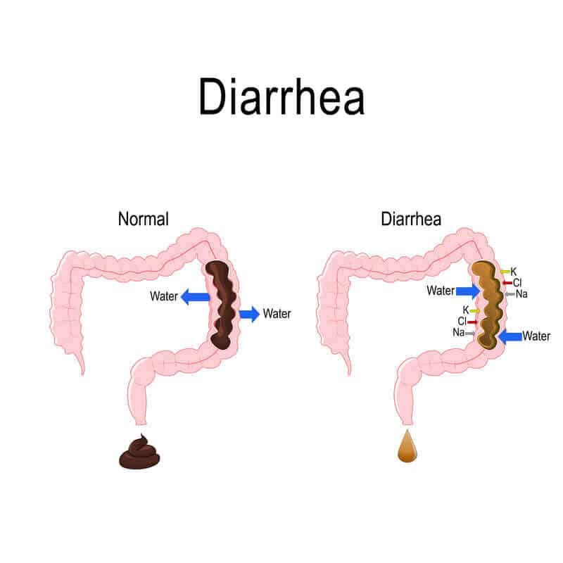 Diarrhea in practice. Case 4
