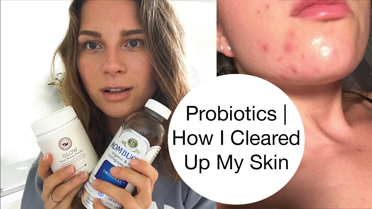 Do Probiotics Help With Acne - HealthyGutClub.com