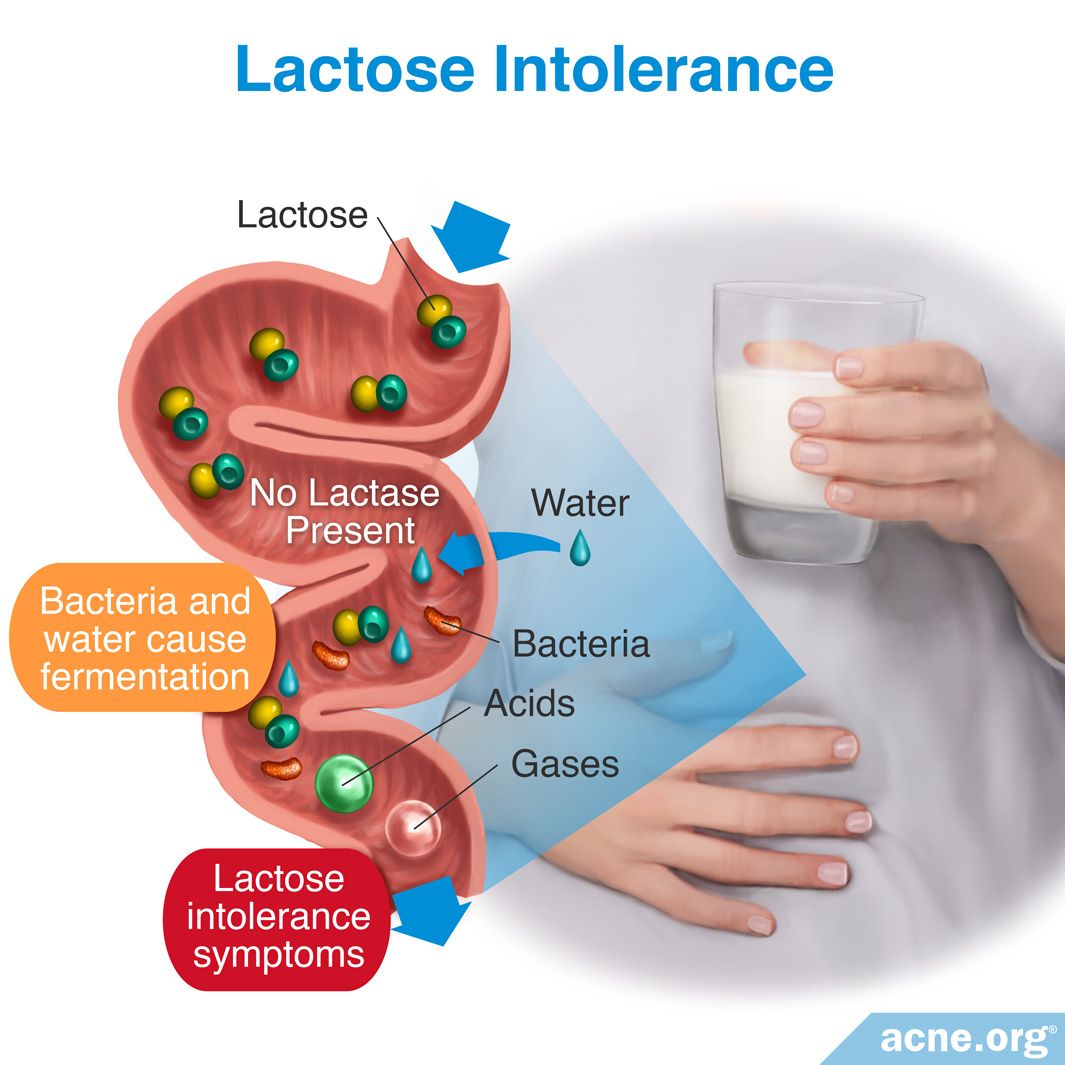Does Lactose Intolerance Relate to Acne?