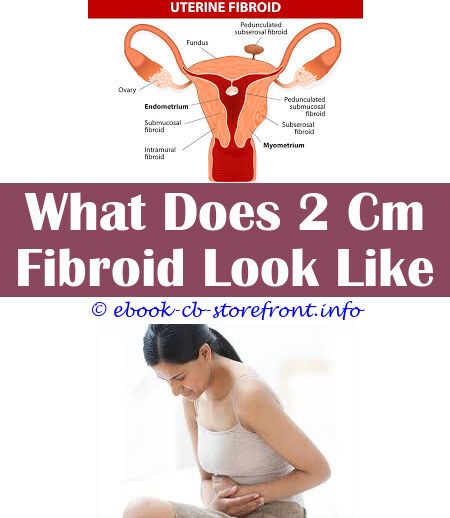 Épinglé sur Fibroid Embolization Recovery