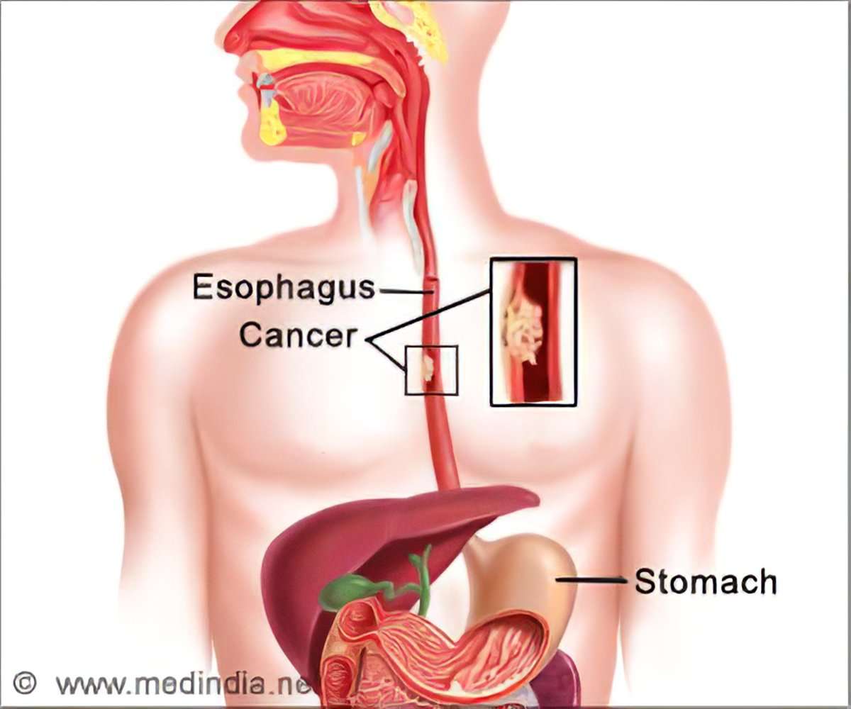 Esophageal Cancer Patients Show Abundance of Oral ...
