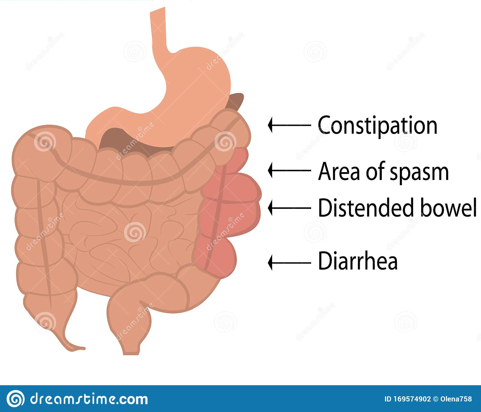 Excess Gas from Human Body.Irritable Bowel Syndrome IBS in a Large ...