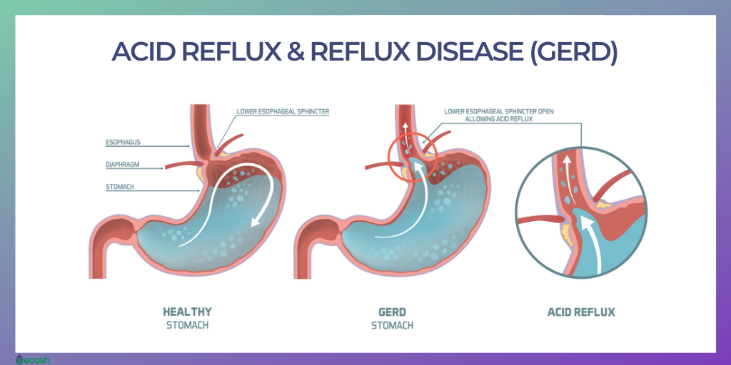GERD vs Heartburn vs Acid Reflux: Find out the Difference ...