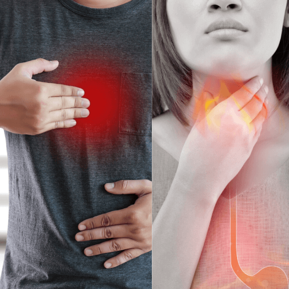 Heartburn Vs Acid Reflux and Other Stories Your Doctor ...