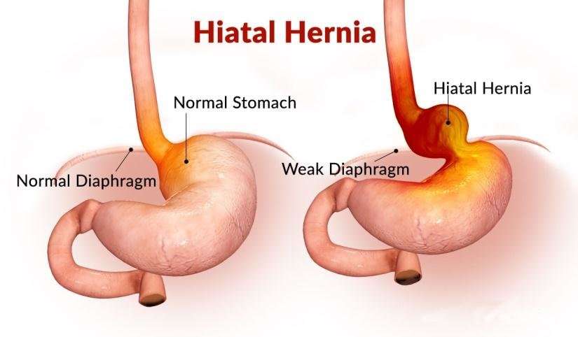 Hiatal Hernia It can be diagnosed if the following symptoms are found ...