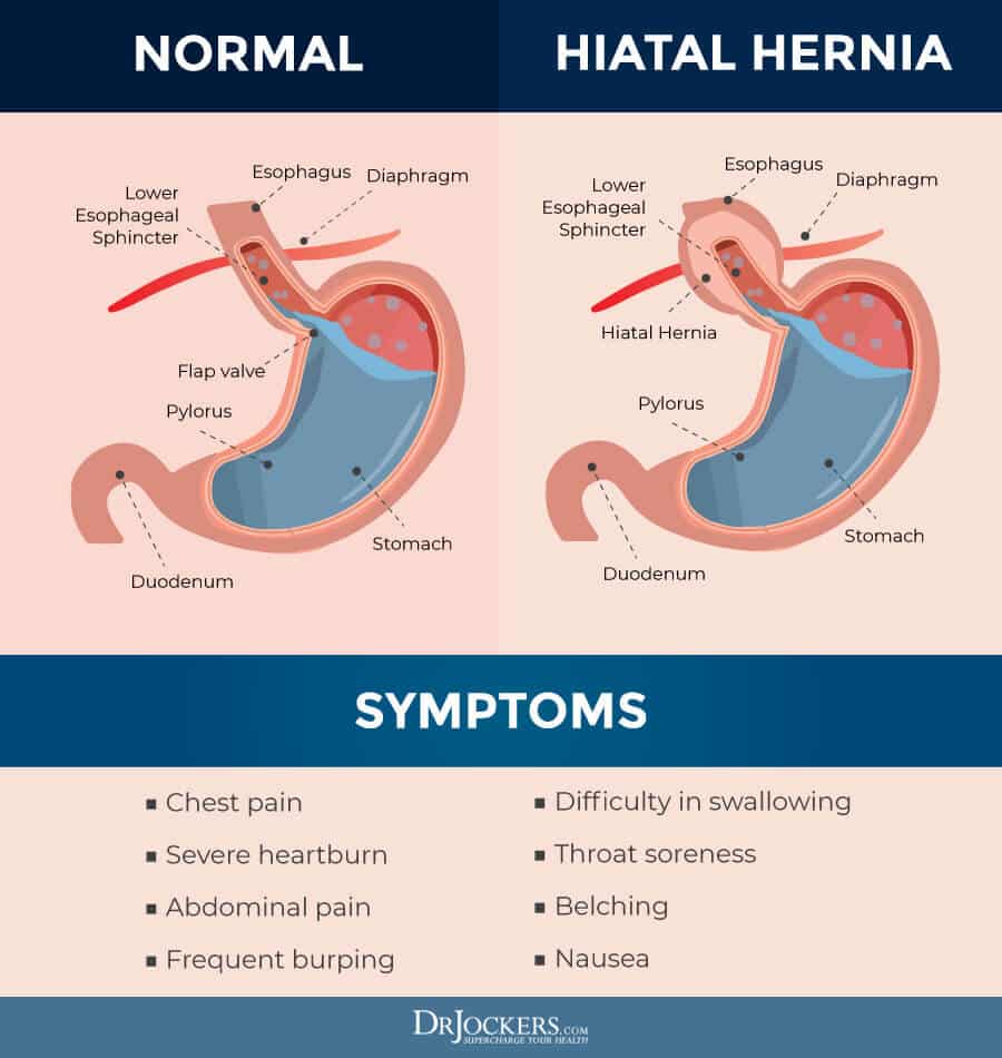 Hiatal Hernia: Symptoms, Causes and Natural Support Strategies