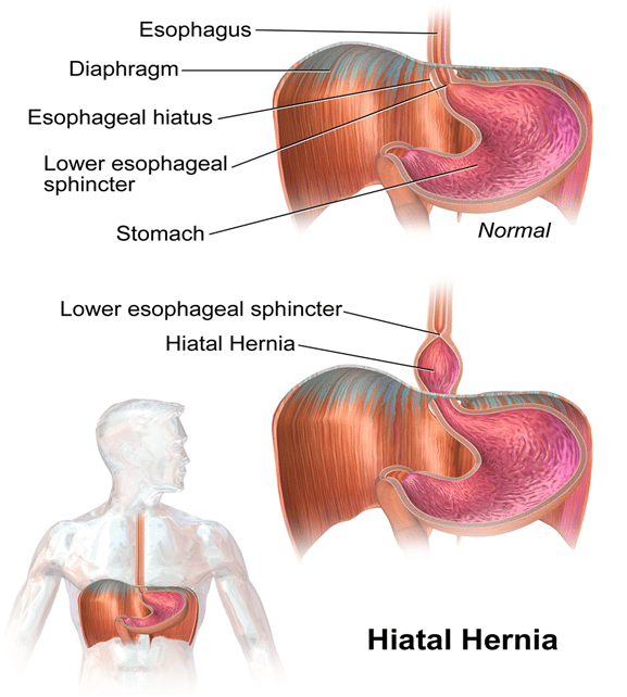 Hiatal Hernia: Symptoms, Causes, and Treatment