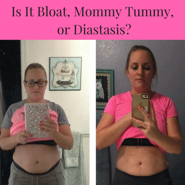 Is It Bloat, Mommy Tummy, or Diastasis?