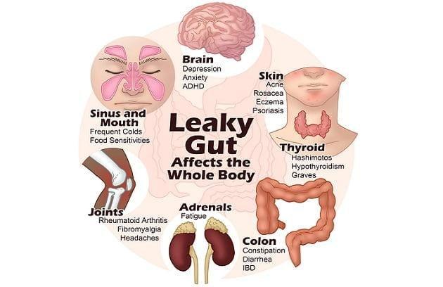 Leaky Gut And Diabetes: Whats The Connection ...