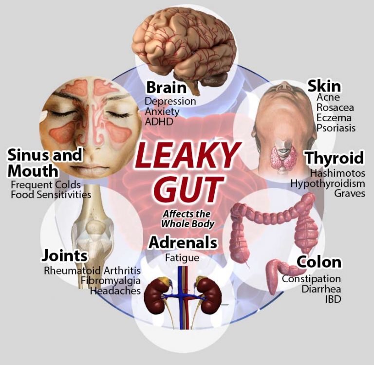 Leaky Gut Symptoms and Treatment
