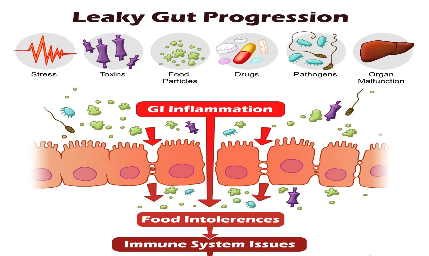 Leaky Gut Syndrome Symptoms, Causes, Tests and Treamtenets
