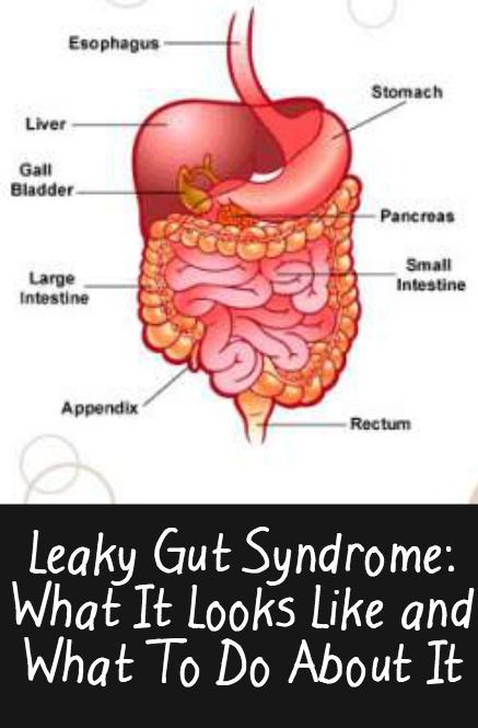 Leaky Gut Syndrome: What It Looks Like and What To Do ...