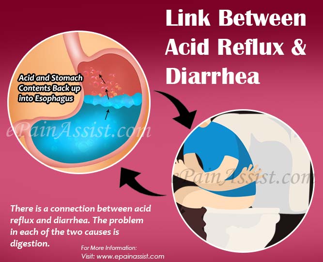 Link Between Acid Reflux &  Diarrhea &  Treatment for ...