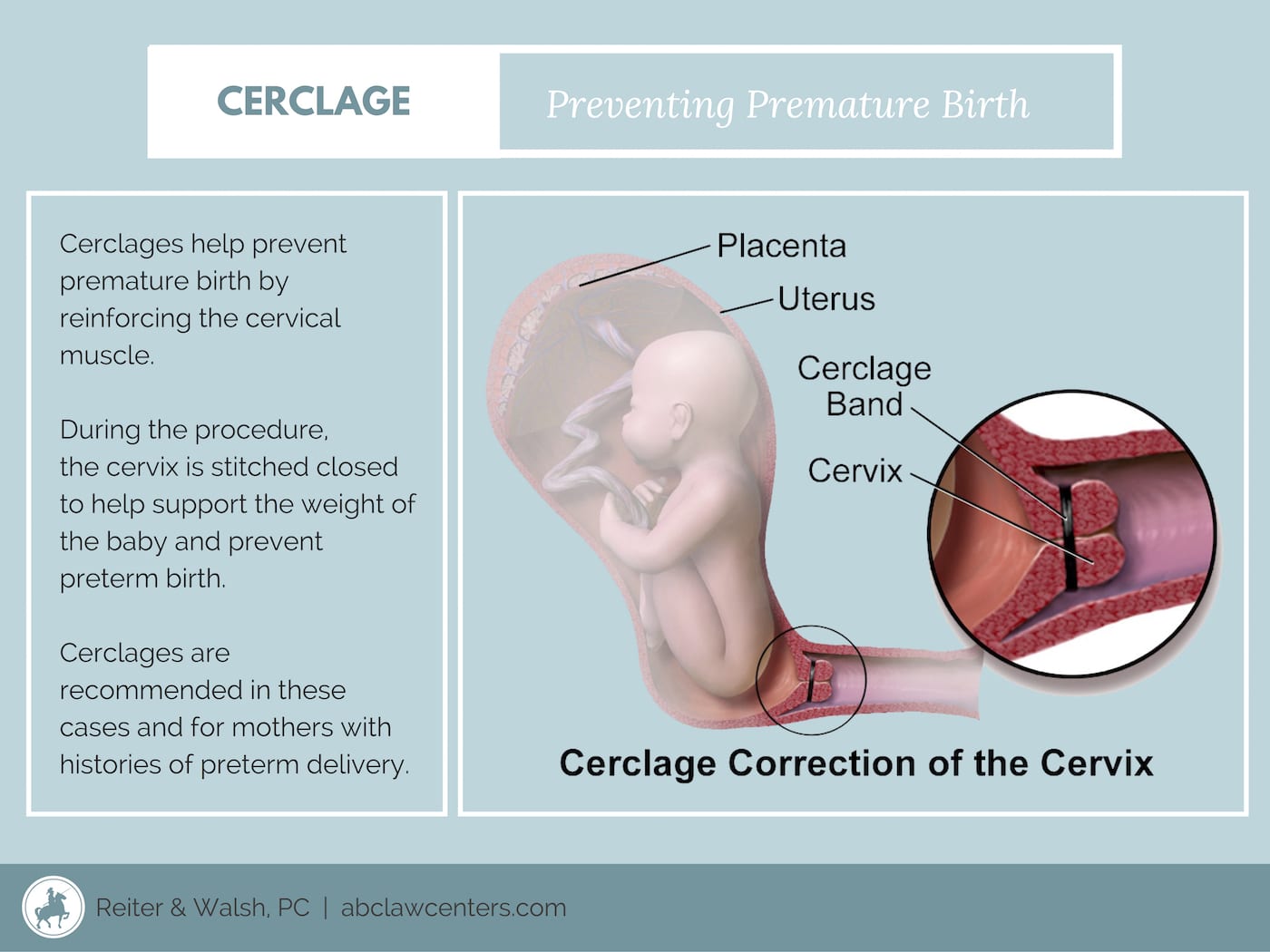 Premature Birth and Cervical Cerclage Lawyers