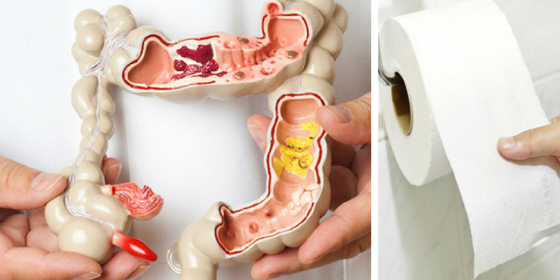 Rectal Bleeding Causes &  5 Natural Ways to Find Relief