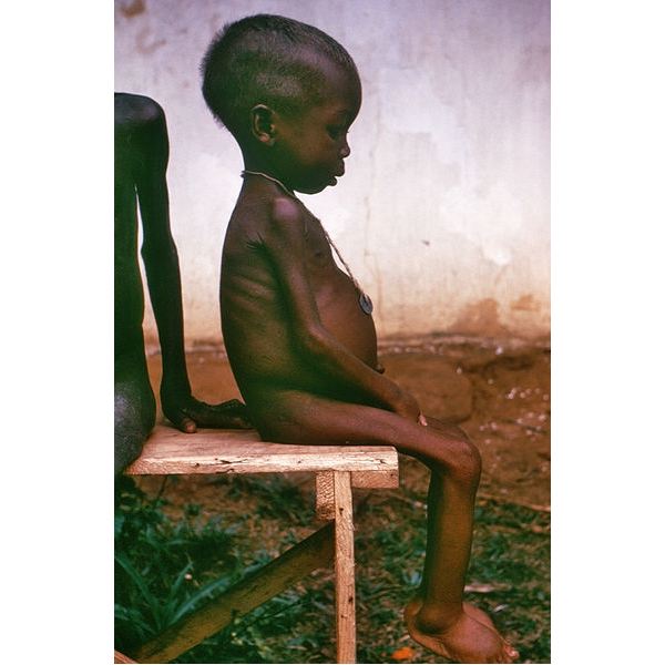 The Effects of Starvation: Facts on How Inadequate ...