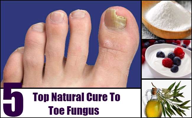 Top 5 Natural Cures For Toe Fungus