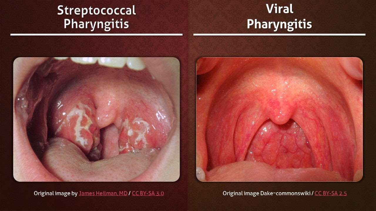 Understanding Pharyngitis (Sore Throats)