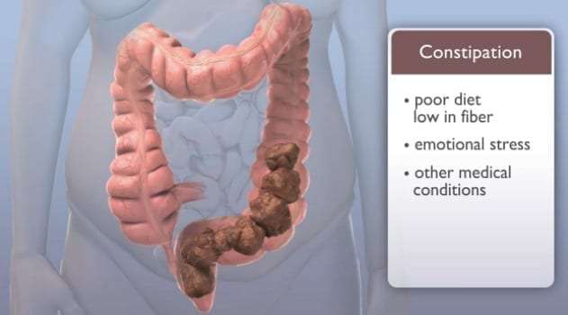 Video: What Causes Constipation?
