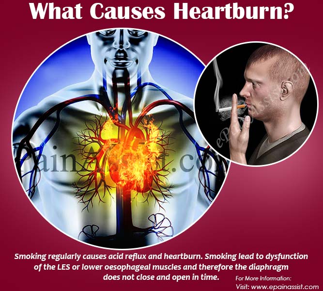 What Causes Heartburn at Night &  How to Prevent the Problem of ...