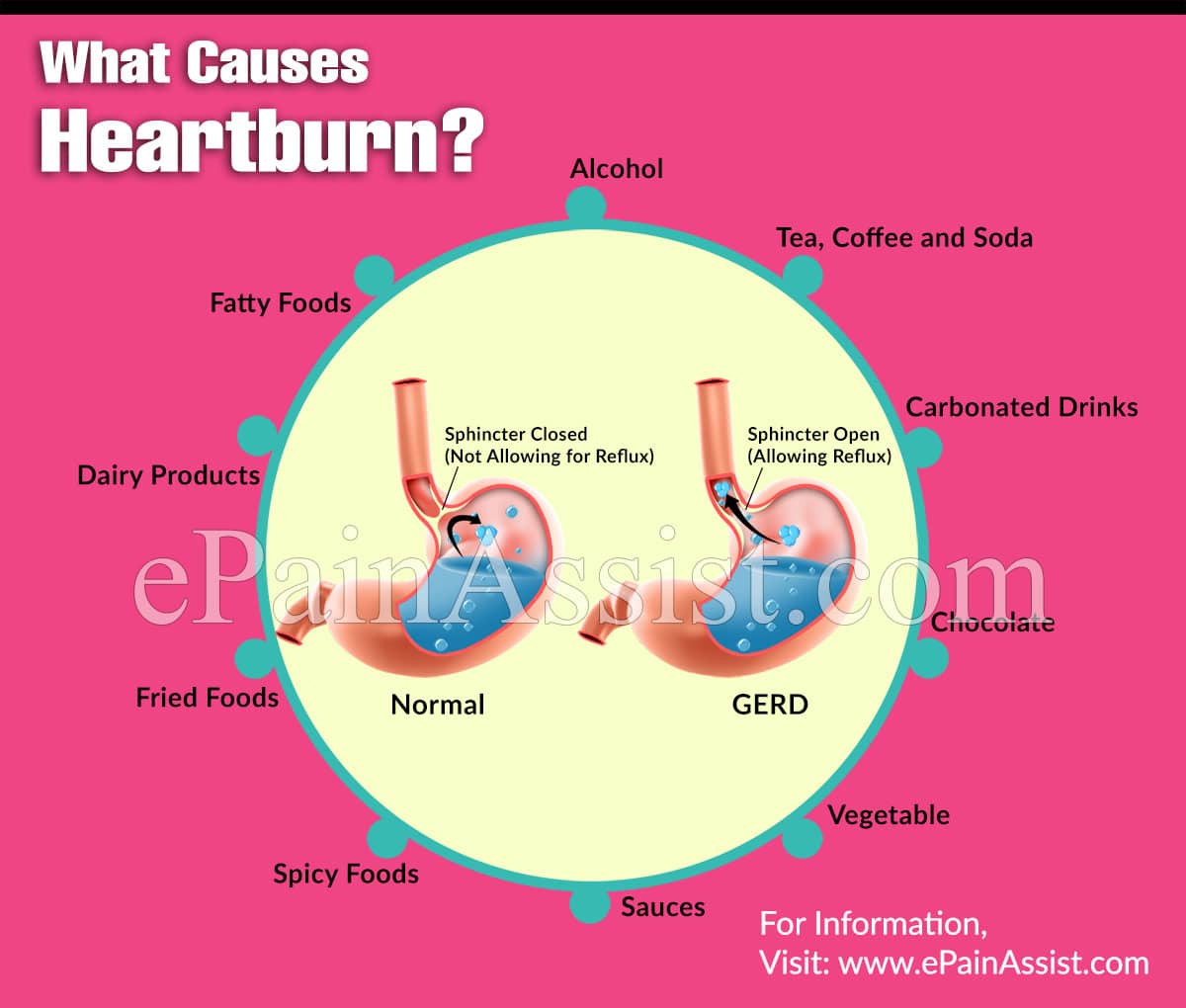 What Causes Heartburn &  What are its Risk Factors?