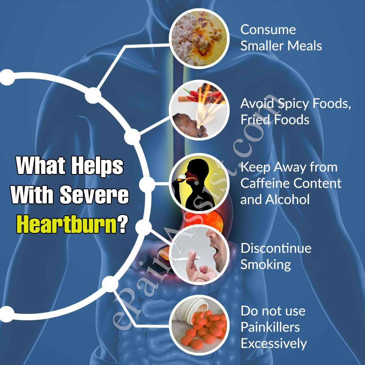 What Helps With Severe Heartburn?