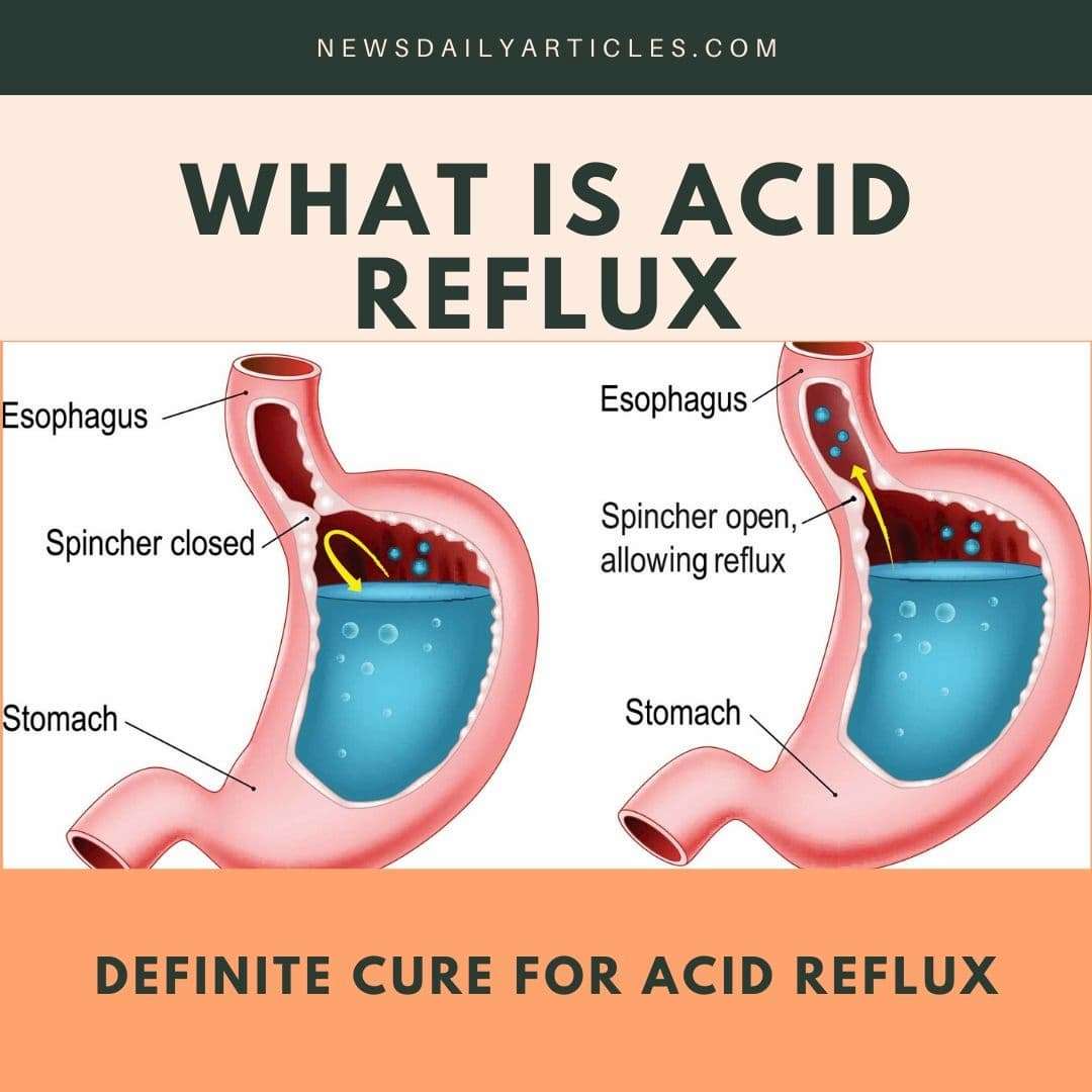 What is acid reflux? Definite cure for acid reflux (June, 2020)