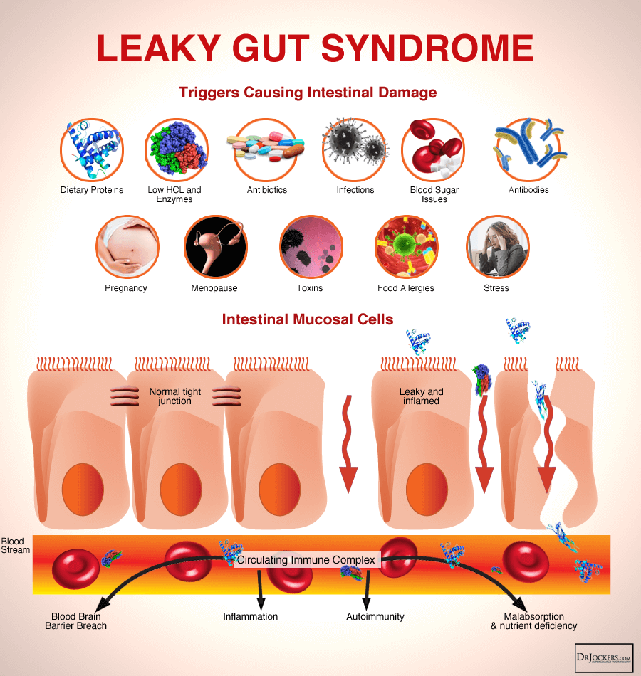 What Is Leaky Gut Syndrome and How Does it Impact our Health?