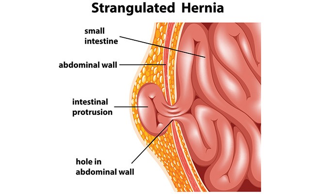 What is That Lump? Recognizing The Signs And Symptoms of Hernias