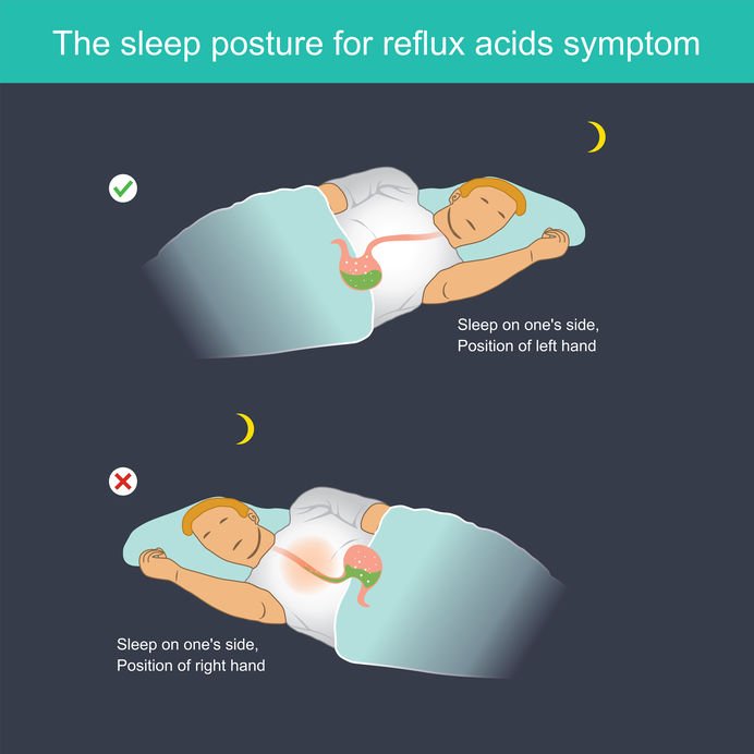 What Is the Best Sleeping Position If I Have Acid Reflux?