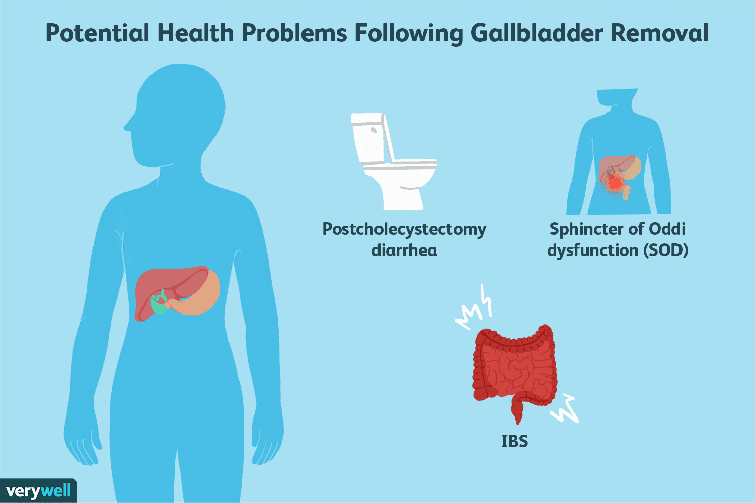 What to Do About IBS After Gallbladder Removal